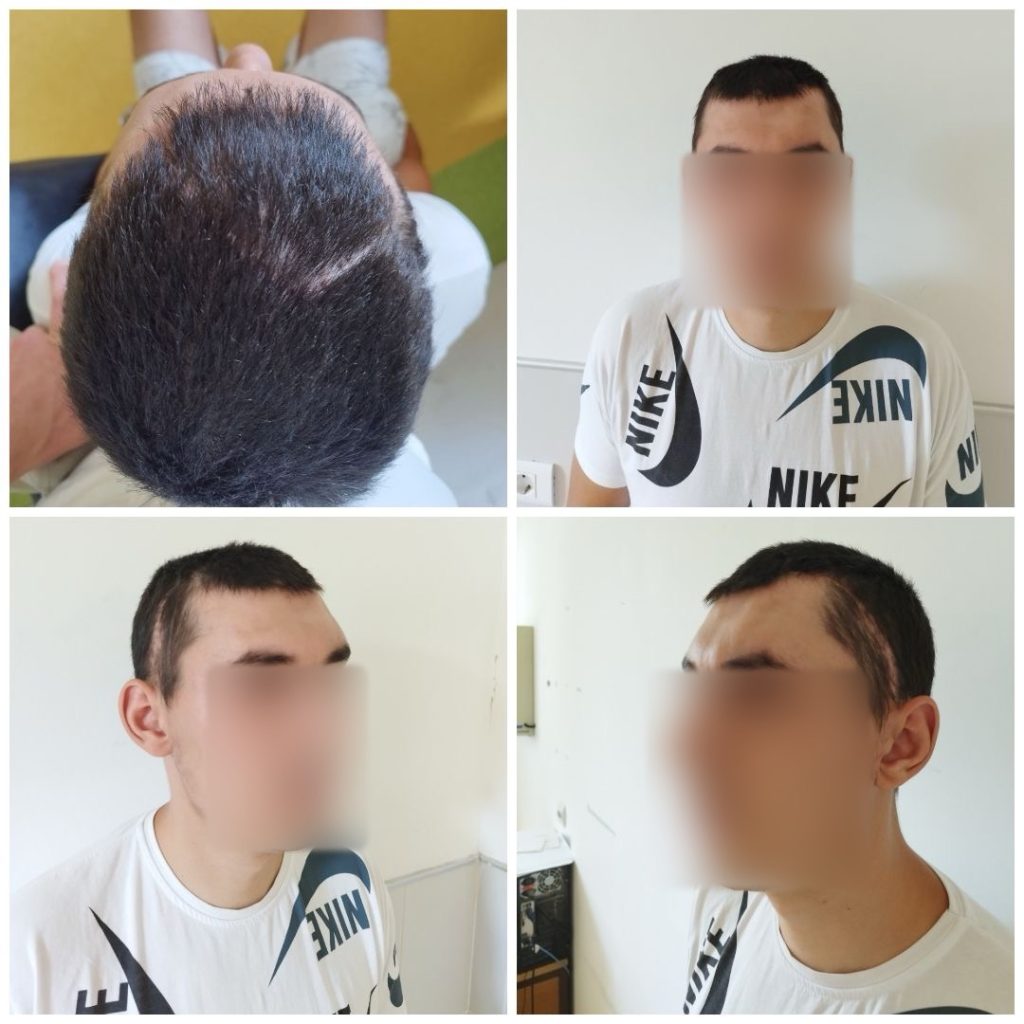Успешна операција со ПММА имплант во болницата Свети Еразмо Охрид